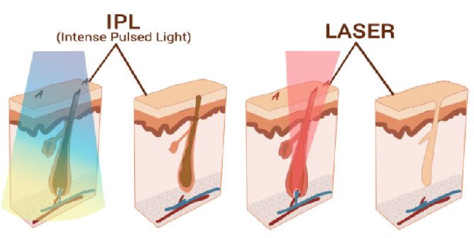 Lausanne Clinic : épilation laser 