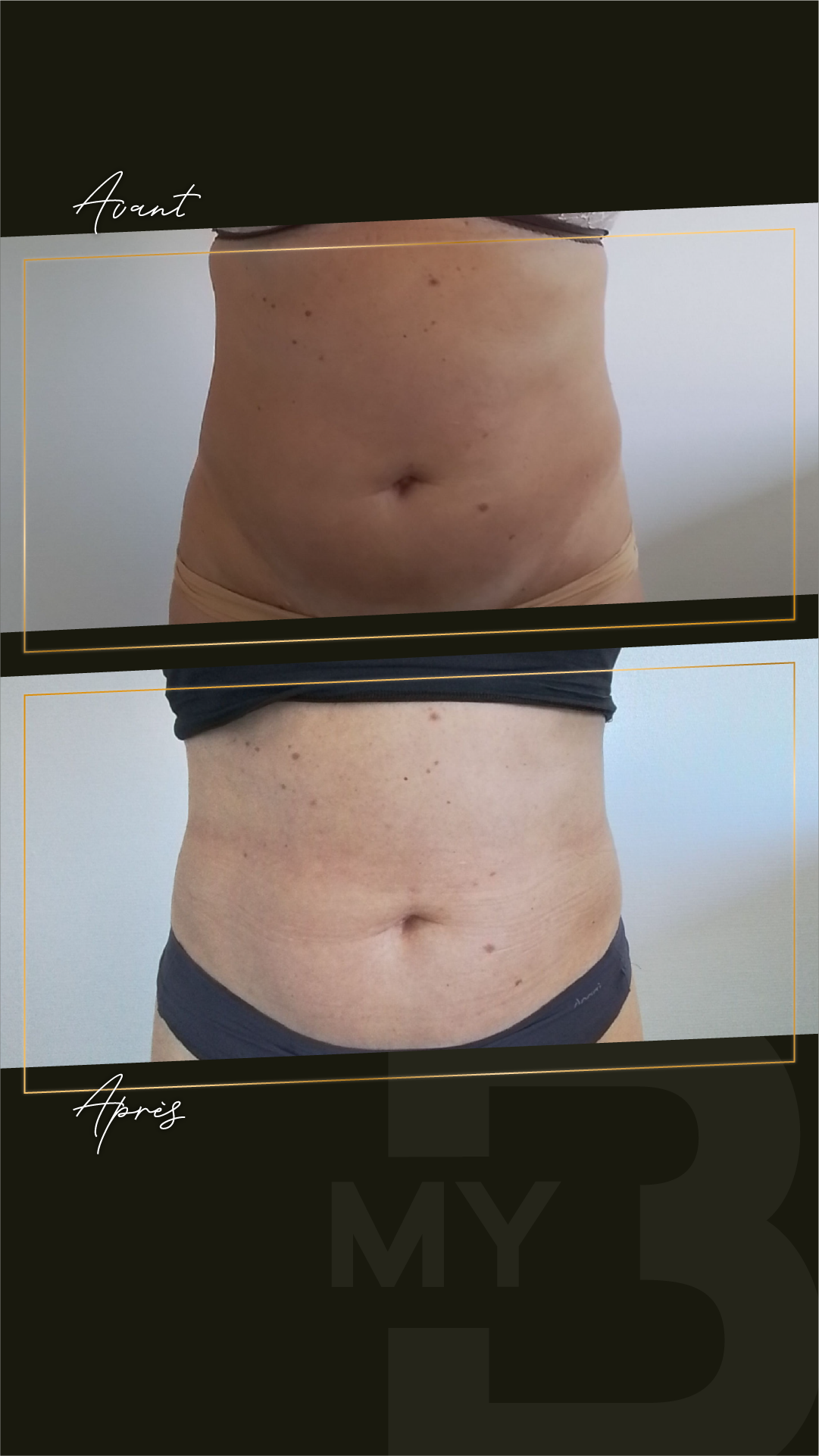 Cryolipolyse ou Coolsculpting c'est la même chose ?