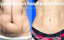 Faire une liposuccion pour l'été à Lausanne : Le Docteur Smarrito nous explique